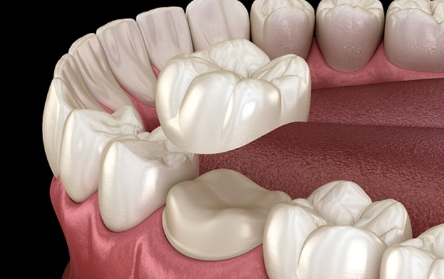 illustration representing dental crowns in Spring Hill