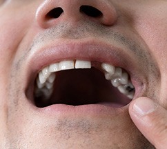 An older man getting dental impressions for dentures