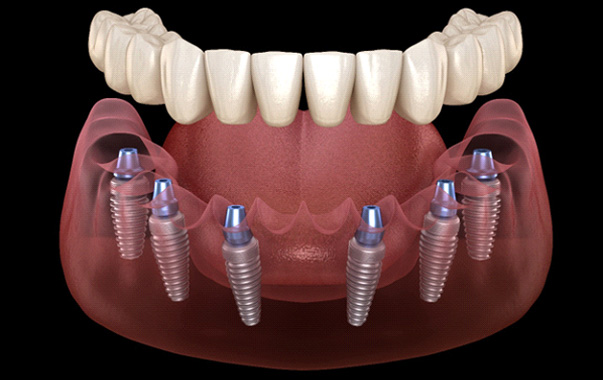 Illustration of implant dentures in Spring Hill, TN for lower arch