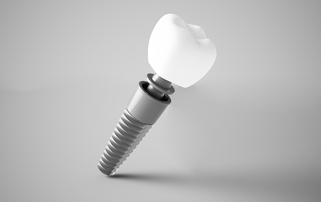 3D render of a dental implant