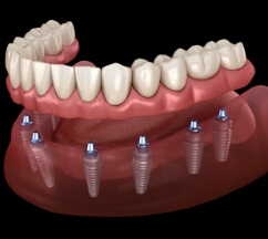 Dental implant components next to a stack of money