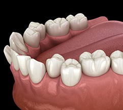 Illustration of crowded teeth