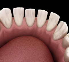 Illustration of gaps in teeth