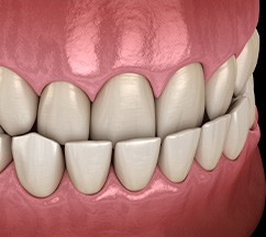 Illustration of underbite