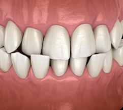 Illustration of crossbite