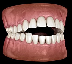 Illustration of open bite
