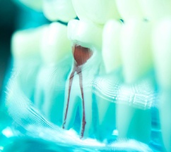Closeup of a damaged tooth requiring root canal