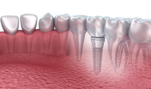 Use a dental implant to replace your missing tooth in Spring Hill.
