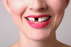 woman smiling missing tooth