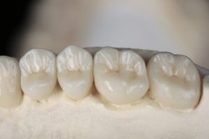 dental crowns placed on a model of a mouth