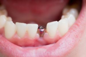 A person with a dental implant in Spring Hill.