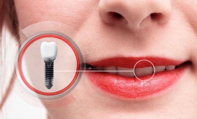 Woman with dental implant