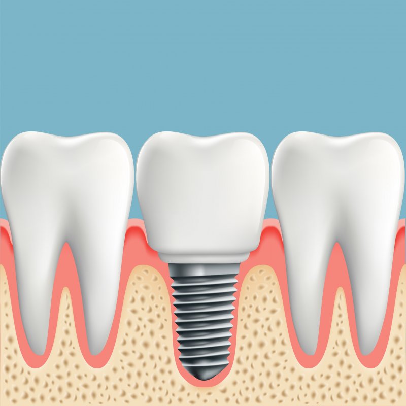 Stock illustration of implant with natural teeth