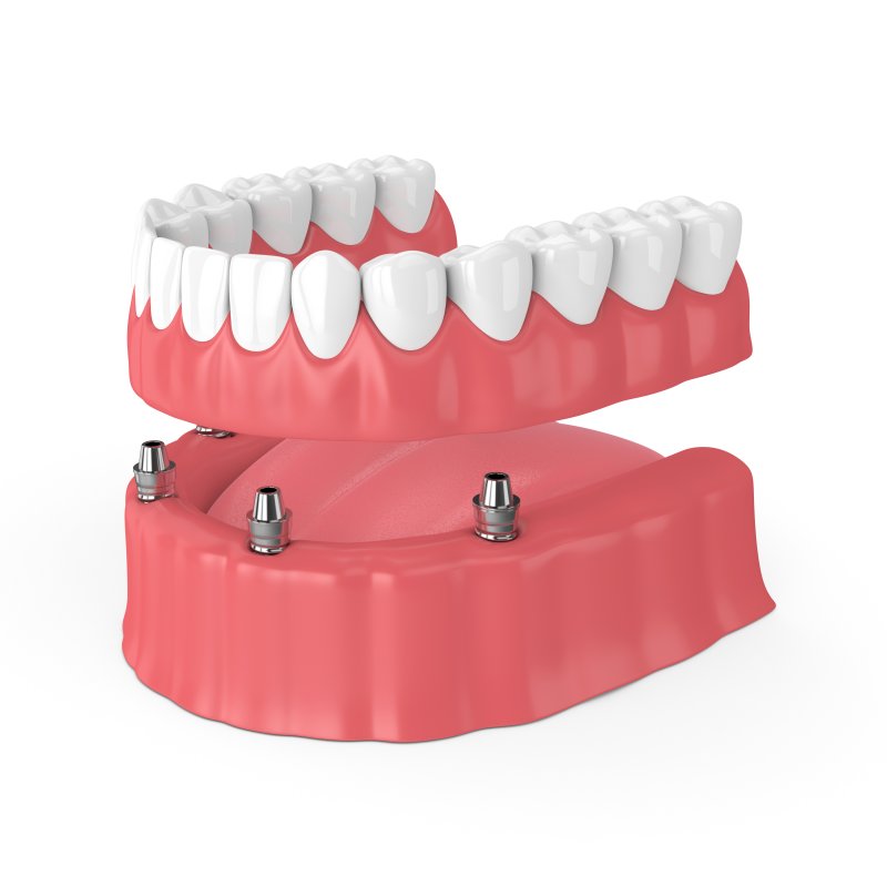 3D rendering of implant dentures