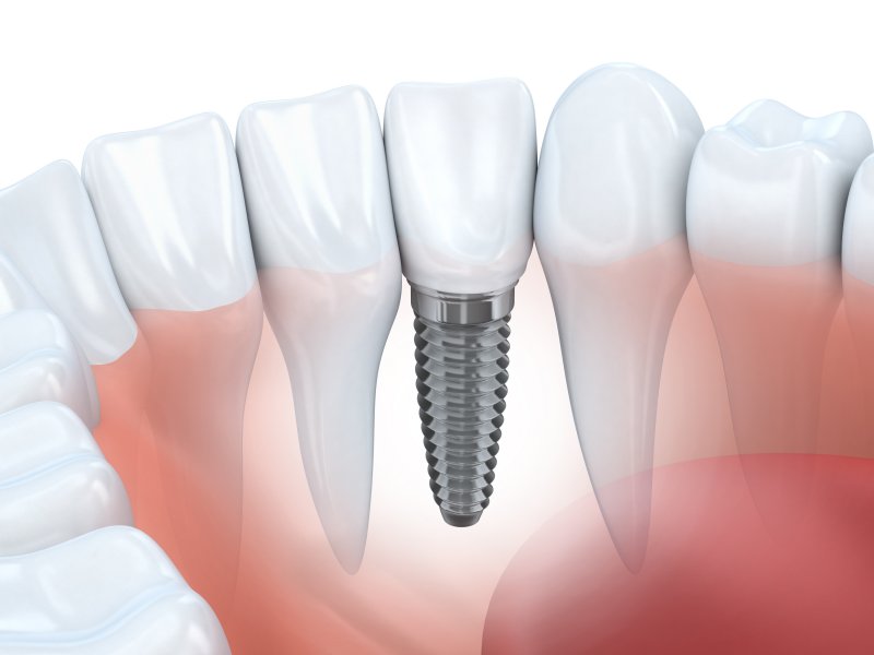 3D illustration of dental implant