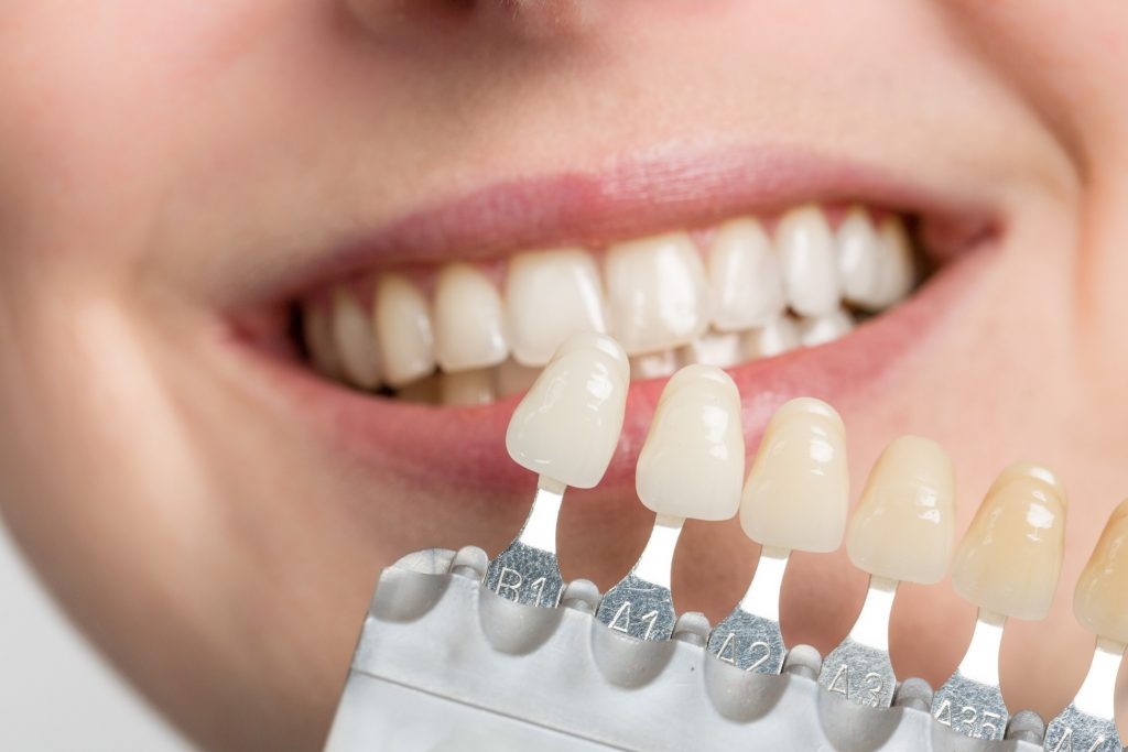 Closeup of dentist shade matching veneers to woman's teeth