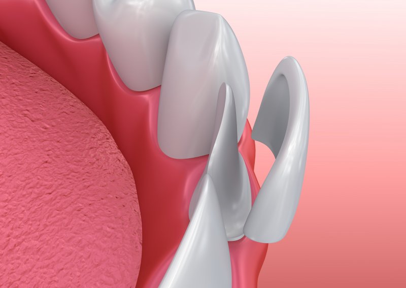 veneers being placed on a smile