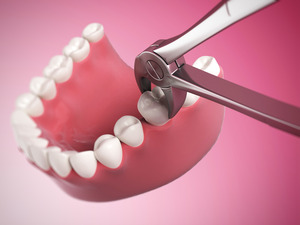 3D render of a tooth extraction
