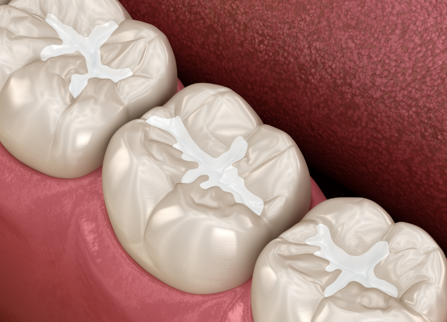 Molars with fillings